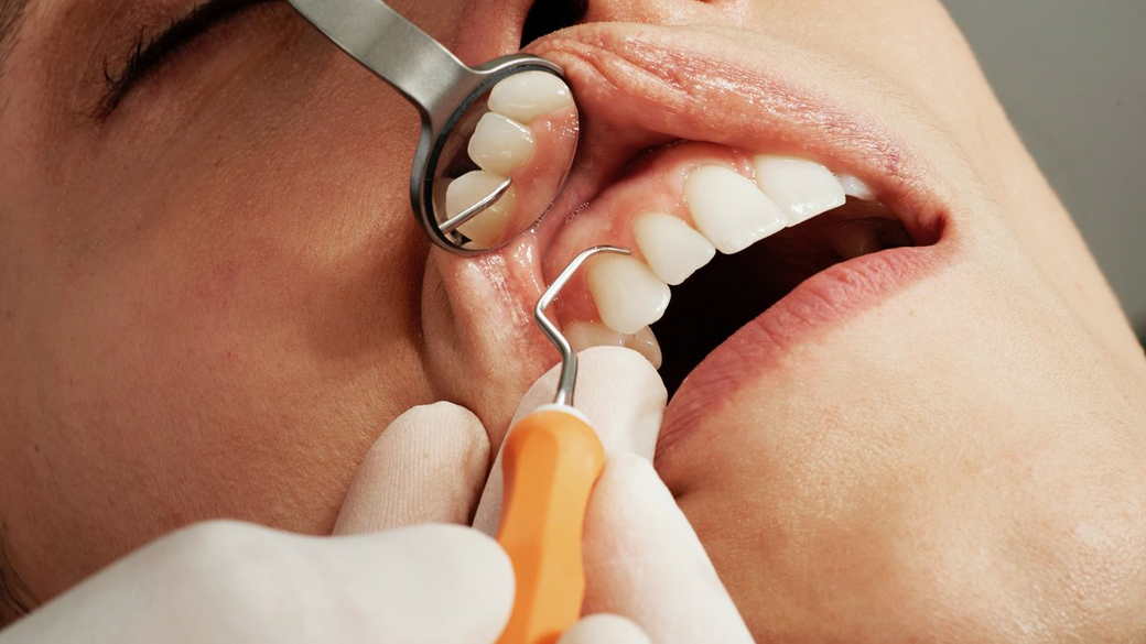 Стоматолог перечислил показания к удалению зубов мудрости